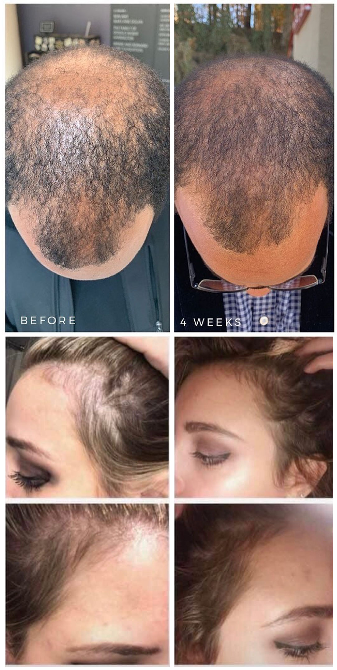 Zenagen before and after pictures